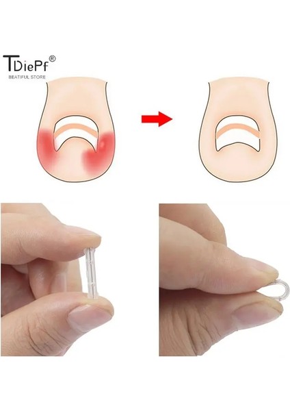 20MM 10 Adet 1 Kutu 10 Adet/kutu Batık Ayak Tırnağı Düzeltme Aracı Batık Ayak Tırnak Tedavisi Elastik Yama Etiket Doğrultma Klip Brace Pedikür Aracı (Yurt Dışından)