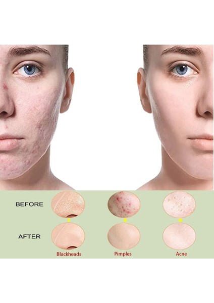 Hp-3pcs Sivilce Cımbız Siyah Nokta Kaldırma Aracı Cilt Bakımı Yüz Akne Temizleme Kiti Siyah Noktalar Temizleyici Profesyonel Sivilce Kiti Güzellik Iyileşmek (Yurt Dışından) modelleri