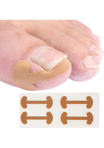 Tip A 5 Sayfalık Tırnak Düzeltme Çıkartmalar Paronişi Tedavisi Batık Ayak Tırnağı Düzeltme Elastik Doğrultma Klip Brace Pedikür Aracı (Yurt Dışından) fırsatları