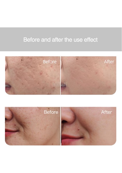 10 Adet Yuvarlak Kablosuz V1 Derma Kalemi LED Ekran ile 5 Seviye Dermapen Mikroiğne Mikroiğneleme Meterapi Yaraları Mts Makinesi (Yurt Dışından) indirimleri