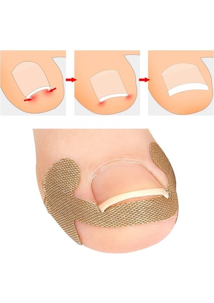 8 Adet 4/8/20 Adet Profesyonel Batık Ayak Tırnağı Ayak Düzeltici Çıkartmalar Esneklik Tırnak Bakımı Pedikür Araçları Sağlık Ayak Tırnaklarını Korur (Yurt Dışından) modelleri