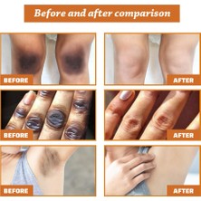Royal Love 3 Adet Acanthosis Nigricans Yağı Koyu Düzeltici Yağ (Yurt Dışından)
