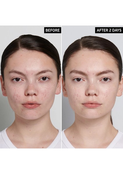 The Inkey Lıst Succinic Acid Acne Treatment - Leke Karşıtı Bakım 15 ml
