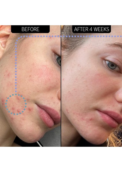 The Inkey Lıst Blemish Clearing Moisturizer 2% Novoretin - Nemlendirici Gece Kremi 50 ml