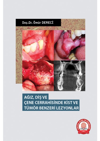 Ağız Diş ve Çene Cerrahisinde Kist ve Tümör Benzeri Lezyonlar - Ömür Dereci