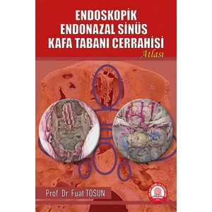 Endoskopik Endonazal Sinüs Kafa Tabanı Cerrahisi