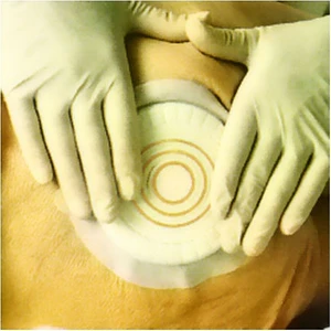 Coloplast 33353 Comfeel Plus Basınç ıcı Hidrokolloid Yara Örtüsü 10 cm