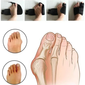 Gece Ateli Ayak Baş Parmak Kemiği Çıkıntısı Bunyon Kemik