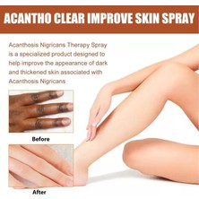 Mingming Shop 30 ml Tarzı Koyu Nokta Giderici 30ML Acantho Şeffaf Sprey Beyazlatıcı Koyu Cilt Koltuk Altı Aydınlatma Mahrem Bölgeler Koltuk Altı Diz Vücut Cilt Bakımı (Yurt Dışından)