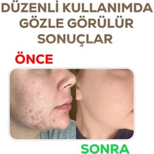 Dermasolin Yağlı ve Akneli Ciltlere Yönelik Güçlü Akne Bakım Seti 3'lü