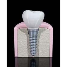 Cestopieno Diş Implantı Çıkarılabilir Uygulama Öğretim Yardımcısı Maket / Dental Implant Model