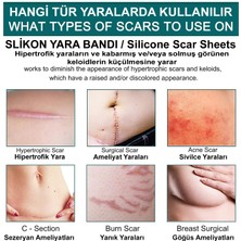 Bienscar Soft Silikon Bant  - Dikiş Izi - Sezaryen - Yanık - Estetik 2cm X 3mt