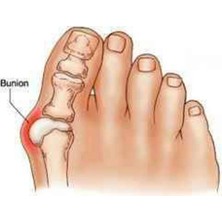 Cmt Silikon Orta Parmağa Geçen Metatarsal Pad