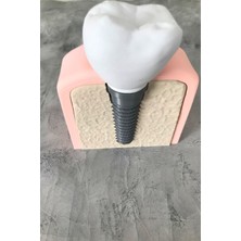 Cestopieno Diş Implantı Çıkarılabilir Uygulama Öğretim Yardımcısı Maket / Dental Implant Model