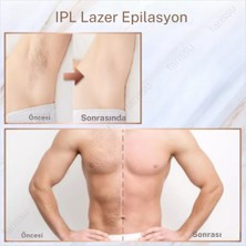 Trend Farma Soğuk Buz Ipl Lazer Epilasyon Cihazı - 999.999 Atım,  Ağrısız Buz Lazer