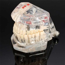 Diş Kliniği Için, Diş Implant Hastalığı Diş Modeli ile Restorasyon Köprü Malocclusion