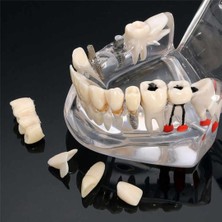 Diş Kliniği Için, Diş Implant Hastalığı Diş Modeli ile Restorasyon Köprü Malocclusion