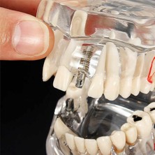 Diş Kliniği Için, Diş Implant Hastalığı Diş Modeli ile Restorasyon Köprü Malocclusion