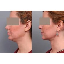 Douxtouche Dr Lipo Mezoterapi Gıdı Eritme, Yanak Inceltme [1 Flakon 5ml Fiyatıdır]