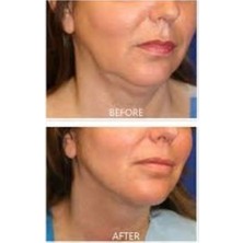 Douxtouche Dr Lipo Mezoterapi Gıdı Eritme, Yanak Inceltme [1 Flakon 5ml Fiyatıdır]