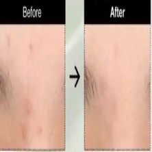 Anua - Heartleaf Centella Red Spot Cream(Leke Kremi)(Globalcare)