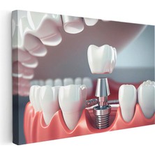 Tablofest Yatay Kanvas Tablo Implant Vidası Yerleştirme Kesiti Diş Hekimi Tablosu Ev Ofis Duvar Dekoru