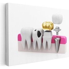 Tablofest Yatay Kanvas Tablo Altın Kaplama ve Implant Diş Diş Hekimi Tablosu Ev Ofis Duvar Dekoru