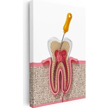 Tablofest Dikey Kanvas Tablo Diş Kökü Kanal Tedavisi Kesiti Diş Hekimi Tablosu Ev Ofis Duvar Dekoru