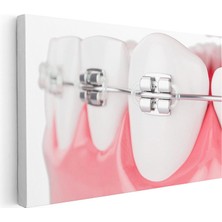 Tablofest Yatay Kanvas Tablo Diş Üzerinde Ortodontik Braketler Diş Hekimi Tablosu Ev Ofis Duvar Dekoru
