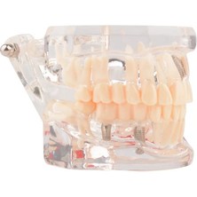 EgeAnatomi Maketleri Diş Hastalıkları Eğitimi Için Restorasyon Köprü Dişi Içeren Implant Patolojik Diş Modeli - Diş Maketi - 6.5 x 6 x 9 cm