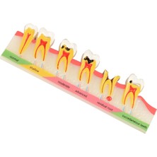 EgeAnatomi Maketleri Diş Çürüğü Gelişim Modeli, 5 Diş Çürüğü Aşaması - Diş Maketi
