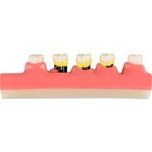 EgeAnatomi Maketleri Periodontal Hastalık Sınıflandırma Modeli - Diş Maketi - 15 x 3 x 5cm