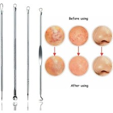 Skygo Siyah Nokta Akne Temizleyici 4'lü Kutulu Paslanmaz Komedon Gümüş Komedon Seti Sivilce Siyah Nokta Çıkarıcı Kaliteli