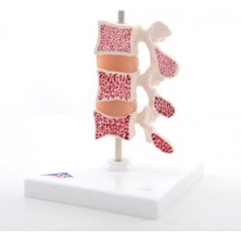 EgeAnatomi Maketleri Osteoporoz Modeli, 3 Omur