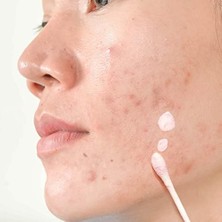 Uslucan Alışveriş Akne Karşıtı Losyon 30 ml