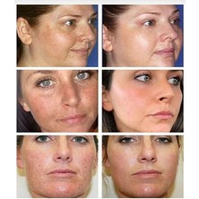 Kanza Cilt Beyazlatıcı, Krem, Sabun ve Serum 3'lü Set