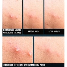 Yul Acne Spot Patch Super Thin - Süper Ince Sivilce Bandı