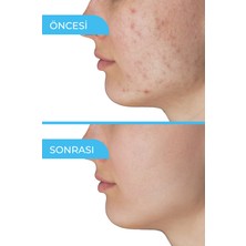 Akne Sivilce Gözenek Siyah Nokta Karşıtı Krem Yağlı Karma Ciltler Için Nemlendirici Leke Karşıtı