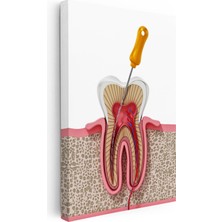 Kanvas Tablo Diş Kökü Kanal Tedavisi Kesiti Diş Hekimi Tablosu Ev Ofis Duvar Dekoru