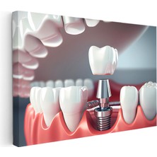 Kanvas Tablo Implant Vidası Yerleştirme Kesiti Diş Hekimi Tablosu Ev Ofis Duvar Dekoru