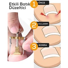 Popüler Sepet Batık Tırnak Çıkartıcı Orijinal Çelik Batan Tırnağı Düzeltme Aparatı Düzeltici Aleti Çıkarıcı Aparat
