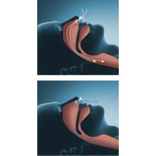 Horlama Önleyici Rahat Uyku Aparatı