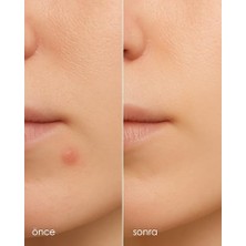 Bistopia Stopever Clearly Spot Patch, Sivilce Karşıtı Şeffaf Plaster | Şeffaf, Ultra Ince, Hidrokolloid +  + Salicylic Asit Içerikli Akne Karşıtı Yüz Bandı | 24 Adet