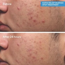 Gndz Store Murad Relief Spot Treatment - Lokal Sivilce Kurutucu Jel 1 Paket (1 x 15 Ml)