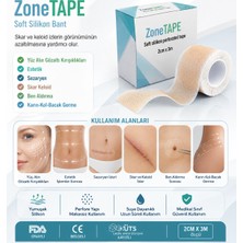 Zonetape MZ001 Soft Silikon Bant 2 cm x 3 M – Skar ve Keloid Iz Bakımı Için Medikal Silikon Bant