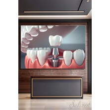 Şehzat Yatay Tekli Kanvas Duvar Tablosu Modern Ağız Diş Sağlığı Dişçi Poliklinik Hastane Dental Implant