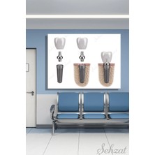 Şehzat Yatay Tekli Kanvas Duvar Tablosu Modern Ağız Diş Sağlığı Dişçi Klinik Dental Implant
