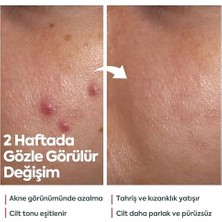 Akne Kremi Yüz Için – Sivilce ve Akne Karşıtı Leke Kremi – Salisilik Asit & Niasinamid ile Leke Giderici – Genç ve Yetişkin Cilt Bakımı, 40 ml