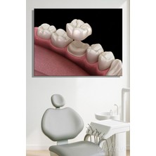 Şehber Kanvas Tablo Yatay Tekli  Ağız Diş Sağlığı Diş Tacı Dental Crown Sabit Protez Türü 2959