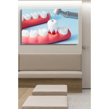 Şehber Kanal Tedavisi (Endodonti) Işlemini Gösteren 3D Bir Illüstrasyon Yatay Kanvas Tablo Tekli 3591